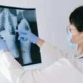 Fratture ossee: prevenzione e opzioni di trattamento per mantenere la salute ossea
